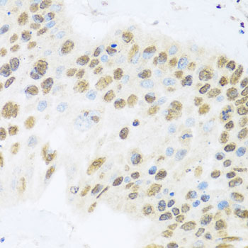 ZBTB17 / MIZ-1 Antibody - Immunohistochemistry of paraffin-embedded human lung cancer tissue.