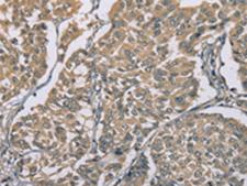 ZBTB2 Antibody - Immunohistochemistry of paraffin-embedded Human breast cancer tissue  using ZBTB2  Polyclonal Antibody at dilution of 1:50(×200)