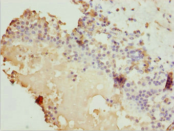 ZBTB20 Antibody - Immunohistochemistry of paraffin-embedded human breast cancer at dilution 1:100