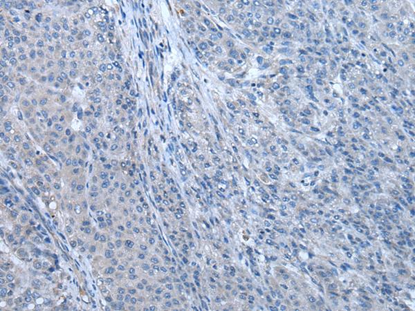 ZBTB3 Antibody - Immunohistochemistry of paraffin-embedded Human liver cancer tissue  using ZBTB3 Polyclonal Antibody at dilution of 1:55(×200)