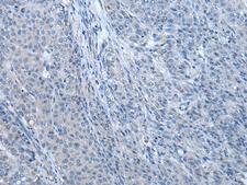 ZBTB3 Antibody - Immunohistochemistry of paraffin-embedded Human liver cancer tissue  using ZBTB3 Polyclonal Antibody at dilution of 1:55(×200)