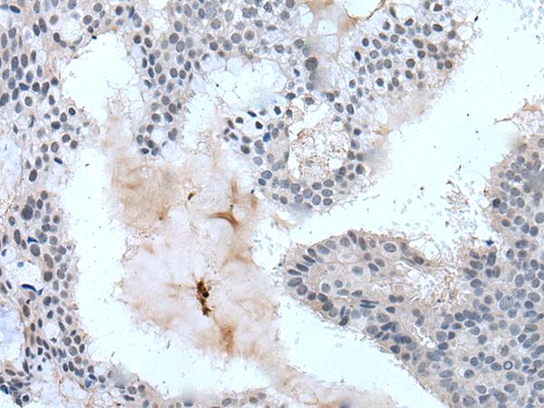 ZBTB3 Antibody - Immunohistochemistry of paraffin-embedded Human breast cancer tissue  using ZBTB3 Polyclonal Antibody at dilution of 1:55(×200)