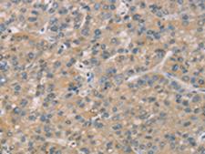 ZBTB3 Antibody - Immunohistochemistry of paraffin-embedded Human liver cancer tissue  using ZBTB3  Polyclonal Antibody at dilution of 1:50(×200)