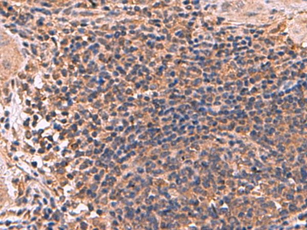 ZBTB33 / Kaiso Antibody - Immunohistochemistry of paraffin-embedded Human cervical cancer tissue  using ZBTB33 Polyclonal Antibody at dilution of 1:30(×200)