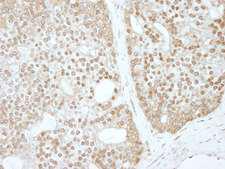 ZBTB40 Antibody - Detection of Human ZBTB40 by Immunohistochemistry. Sample: FFPE section of human prostate carcinoma. Antibody: Affinity purified rabbit anti-ZBTB40 used at a dilution of 1:1000 (1 ug/ml). Detection: DAB.