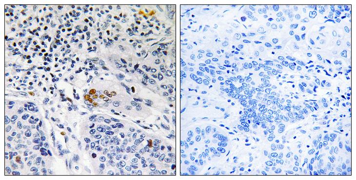 ZBTB40 Antibody - Peptide - + Immunohistochemistry analysis of paraffin-embedded human lung carcinoma tissue, using ZBTB40 antibody.