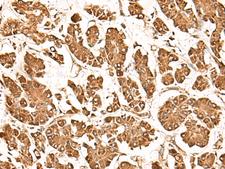 ZBTB43 Antibody - Immunohistochemistry of paraffin-embedded Human gastric cancer tissue  using ZBTB43 Polyclonal Antibody at dilution of 1:40(×200)