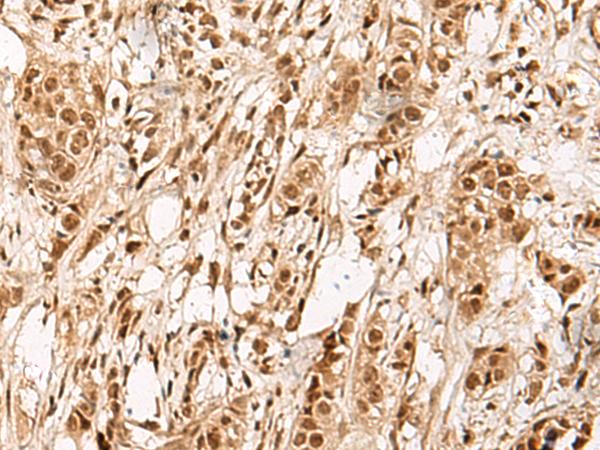 ZBTB43 Antibody - Immunohistochemistry of paraffin-embedded Human breast cancer tissue  using ZBTB43 Polyclonal Antibody at dilution of 1:90(×200)