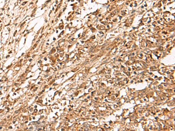 ZBTB43 Antibody - Immunohistochemistry of paraffin-embedded Human liver cancer tissue  using ZBTB43 Polyclonal Antibody at dilution of 1:90(×200)