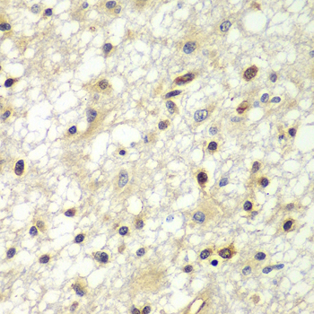 ZBTB48 / HKR3 Antibody - Immunohistochemistry of paraffin-embedded human brain cancer tissue.