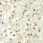 ZBTB48 / HKR3 Antibody - Immunohistochemistry of paraffin-embedded human brain cancer tissue.