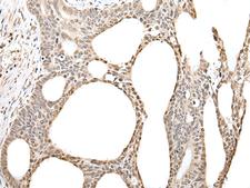 ZBTB5 Antibody - Immunohistochemistry of paraffin-embedded Human gastric cancer tissue  using ZBTB5 Polyclonal Antibody at dilution of 1:40(×200)
