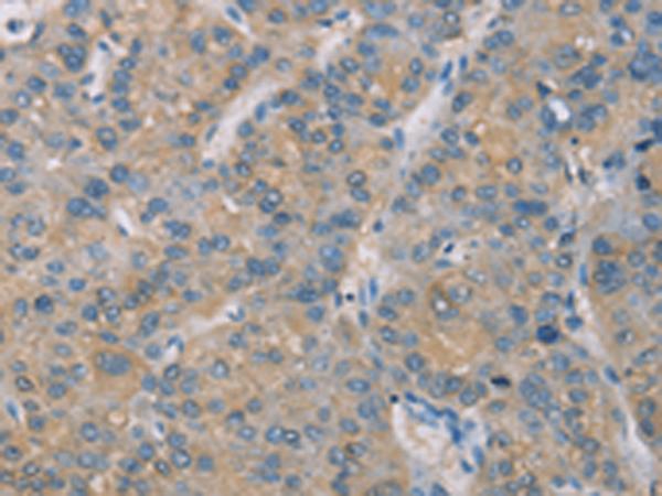 ZBTB6 Antibody - Immunohistochemistry of paraffin-embedded Human liver cancer tissue  using ZBTB6  Polyclonal Antibody at dilution of 1:50(×200)