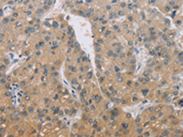ZBTB6 Antibody - Immunohistochemistry of paraffin-embedded Human liver cancer tissue  using ZBTB6  Polyclonal Antibody at dilution of 1:50(×200)