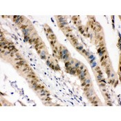 ZBTB7A / Pokemon Antibody - ZBTB7A was detected in paraffin-embedded sections of human intestinal cancer tissues using rabbit anti- ZBTB7A Antigen Affinity purified polyclonal antibody at 1 ug/mL. The immunohistochemical section was developed using SABC method.