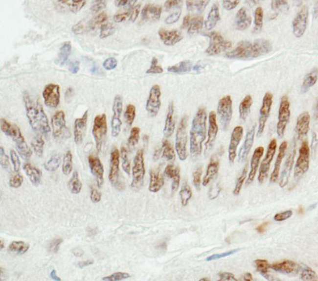 ZBTB7A / Pokemon Antibody - Detection of Human ZBTB7/FBI-1 by Immunohistochemistry. Sample: FFPE section of human colon carcinoma. Antibody: Affinity purified rabbit anti-ZBTB7/FBI-1 used at a dilution of 1:200 (1 ug/ml). Detection: DAB.