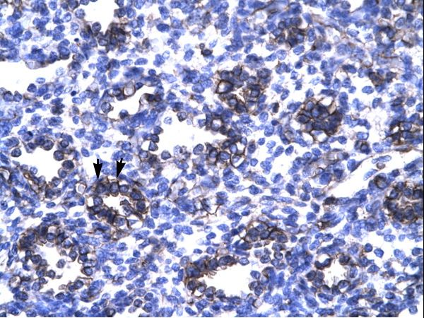 ZBTB7B / HcKrox Antibody - ZBTB7B antibody ARP32749_T100-NP_056956-ZFP67 Antibody was used in IHC to stain formalin-fixed, paraffin-embedded human lung.  This image was taken for the unconjugated form of this product. Other forms have not been tested.