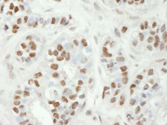 ZC3H11A Antibody - Detection of Human ZC3H11A by Immunohistochemistry. Sample: FFPE section of human breast carcinoma. Antibody: Affinity purified rabbit anti-ZC3H11A used at a dilution of 1:100.