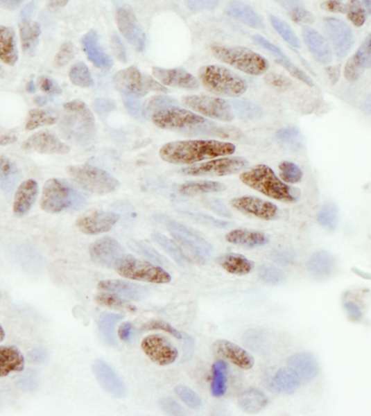 ZC3H11A Antibody - Detection of Human ZC3H11A by Immunohistochemistry. Sample: FFPE section of human ovarian carcinoma. Antibody: Affinity purified rabbit anti-ZC3H11A used at a dilution of 1:100.