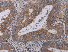 ZC3H12A / MCPIP1 Antibody - Immunohistochemistry of paraffin-embedded Human colon cancer using ZC3H12A Polyclonal Antibody at dilution of 1:40.