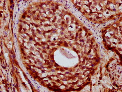 ZC3H14 Antibody - Immunohistochemistry Dilution at 1:400 and staining in paraffin-embedded human cervical cancer performed on a Leica BondTM system. After dewaxing and hydration, antigen retrieval was mediated by high pressure in a citrate buffer (pH 6.0). Section was blocked with 10% normal Goat serum 30min at RT. Then primary antibody (1% BSA) was incubated at 4°C overnight. The primary is detected by a biotinylated Secondary antibody and visualized using an HRP conjugated SP system.