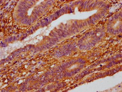 ZC3H14 Antibody - Immunohistochemistry Dilution at 1:400 and staining in paraffin-embedded human colon cancer performed on a Leica BondTM system. After dewaxing and hydration, antigen retrieval was mediated by high pressure in a citrate buffer (pH 6.0). Section was blocked with 10% normal Goat serum 30min at RT. Then primary antibody (1% BSA) was incubated at 4°C overnight. The primary is detected by a biotinylated Secondary antibody and visualized using an HRP conjugated SP system.