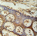 ZC3H3 Antibody - ZC3H3 Antibody immunohistochemistry of formalin-fixed and paraffin-embedded human skin carcinoma followed by peroxidase-conjugated secondary antibody and DAB staining.