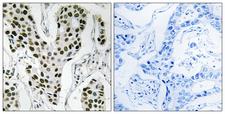 ZC3H4 Antibody - Peptide - + Immunohistochemistry analysis of paraffin-embedded human breast carcinoma tissue using ZC3H4 antibody.