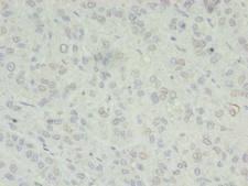ZC3H7A Antibody - Immunohistochemistry of paraffin-embedded human liver cancer using antibody at dilution of 1:100.