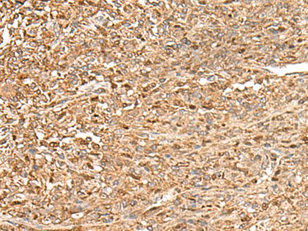 ZC3H7A Antibody - Immunohistochemistry of paraffin-embedded Human liver cancer tissue  using ZC3H7A Polyclonal Antibody at dilution of 1:50(×200)