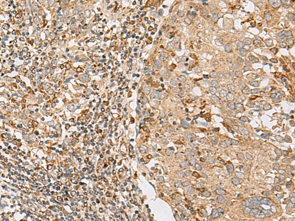 ZC3H7A Antibody - Immunohistochemistry of paraffin-embedded Human cervical cancer tissue  using ZC3H7A Polyclonal Antibody at dilution of 1:50(×200)