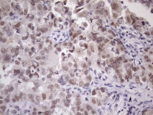 ZC3H8 Antibody - Immunohistochemical staining of paraffin-embedded Adenocarcinoma of Human endometrium tissue using anti-ZC3H8 mouse monoclonal antibody. (Heat-induced epitope retrieval by 1mM EDTA in 10mM Tris buffer. (pH8.5) at 120 oC for 3 min. (1:150)