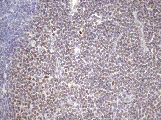 ZC3H8 Antibody - Immunohistochemical staining of paraffin-embedded Human lymphoma tissue using anti-ZC3H8 mouse monoclonal antibody. (Heat-induced epitope retrieval by 1mM EDTA in 10mM Tris buffer. (pH8.5) at 120 oC for 3 min. (1:150)