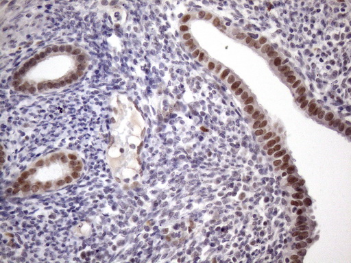 ZC3H8 Antibody - Immunohistochemical staining of paraffin-embedded Carcinoma of Human pancreas tissue using anti-ZC3H8 mouse monoclonal antibody. (Heat-induced epitope retrieval by 1mM EDTA in 10mM Tris buffer. (pH8.5) at 120 oC for 3 min. (1:150)