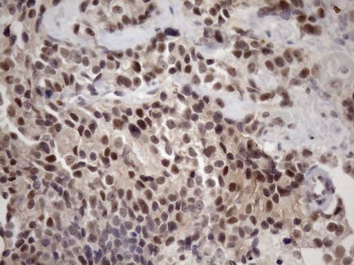 ZC3H8 Antibody - Immunohistochemical staining of paraffin-embedded Adenocarcinoma of Human breast tissue using anti-ZC3H8 mouse monoclonal antibody. (Heat-induced epitope retrieval by 1mM EDTA in 10mM Tris buffer. (pH8.5) at 120 oC for 3 min. (1:150)