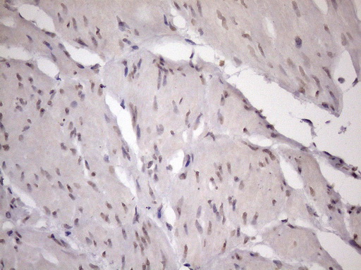 ZC3H8 Antibody - Immunohistochemical staining of paraffin-embedded Carcinoma of Human bladder tissue using anti-ZC3H8 mouse monoclonal antibody. (Heat-induced epitope retrieval by 1mM EDTA in 10mM Tris buffer. (pH8.5) at 120 oC for 3 min. (1:150)