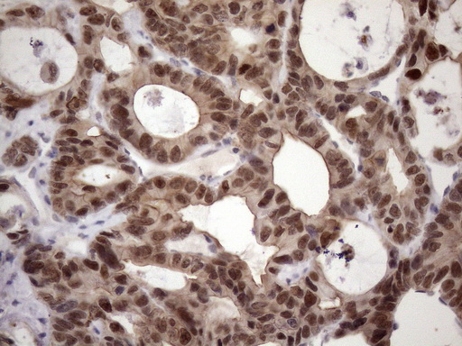 ZC3H8 Antibody - Immunohistochemical staining of paraffin-embedded Adenocarcinoma of Human colon tissue using anti-ZC3H8 mouse monoclonal antibody. (Heat-induced epitope retrieval by 1mM EDTA in 10mM Tris buffer. (pH8.5) at 120 oC for 3 min. (1:150)