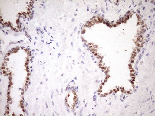 ZC3H8 Antibody - Immunohistochemical staining of paraffin-embedded Carcinoma of Human prostate tissue using anti-ZC3H8 mouse monoclonal antibody. (Heat-induced epitope retrieval by Tris-EDTA, pH8.0)(1:150)