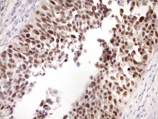 ZC3H8 Antibody - Immunohistochemical staining of paraffin-embedded Carcinoma of Human kidney tissue using anti-ZC3H8 mouse monoclonal antibody. (Heat-induced epitope retrieval by Tris-EDTA, pH8.0)(1:150)