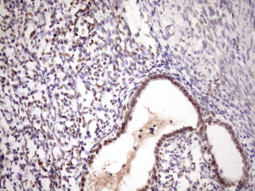 ZC3H8 Antibody - IHC of paraffin-embedded Carcinoma of Human pancreas tissue using anti-ZC3H8 mouse monoclonal antibody. (Heat-induced epitope retrieval by Tris-EDTA, pH8.0)(1:150).