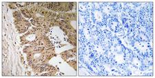 ZC3H8 Antibody - Peptide - + Immunohistochemistry analysis of paraffin-embedded human colon carcinoma tissue, using ZC3H8 antibody.