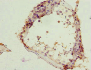 ZC3HC1 / NIPA Antibody - Immunohistochemistry of paraffin-embedded human prostata cancer at dilution 1:100