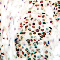 ZC3HC1 / NIPA Antibody - Immunohistochemical analysis of NIPA (pS354) staining in human breast cancer formalin fixed paraffin embedded tissue section. The section was pre-treated using heat mediated antigen retrieval with sodium citrate buffer (pH 6.0). The section was then incubated with the antibody at room temperature and detected using an HRP conjugated compact polymer system. DAB was used as the chromogen. The section was then counterstained with hematoxylin and mounted with DPX.