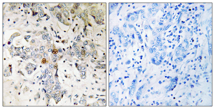 ZCCHC17 / PNO40 / PS1D Antibody - Immunohistochemistry analysis of paraffin-embedded human breast carcinoma tissue, using ZCCHC17 Antibody. The picture on the right is blocked with the synthesized peptide.