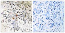 ZCCHC17 / PNO40 / PS1D Antibody - Peptide - + Immunohistochemistry analysis of paraffin-embedded human breast carcinoma tissue using ZCCHC17 antibody.