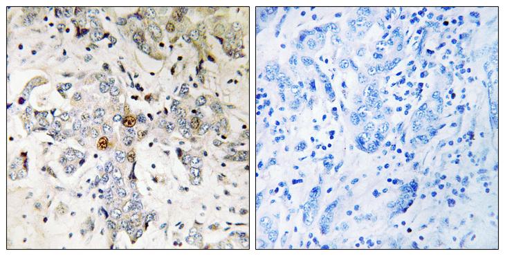 ZCCHC17 / PNO40 / PS1D Antibody - Peptide - + Immunohistochemistry analysis of paraffin-embedded human breast carcinoma tissue using ZCCHC17 antibody.