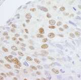 ZCCHC8 Antibody - Detection of Human ZCCHC8 by Immunohistochemistry. Sample: FFPE section of human breast carcinoma. Antibody: Affinity purified rabbit anti-ZCCHC8 used at a dilution of 1:250.