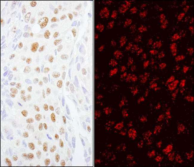 ZCCHC8 Antibody - Detection of Human ZCCHC8 by Immunohistochemistry and Immunofluorescence. Sample: FFPE sections of human breast carcinoma. Antibody: Affinity purified rabbit anti-ZCCHC8 used at a dilution of 1:5000 (0.2 ug/ml) and 1:2000 (0.5 ug/ml). Detection: DAB and Red-fluorescent Goat anti-Rabbit IgG-heavy and light chain, cross-adsorbed Antibody DyLight 594 Conjugated used at a dilution of 1:100.