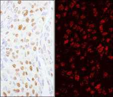 ZCCHC8 Antibody - Detection of Human ZCCHC8 by Immunohistochemistry and Immunofluorescence. Sample: FFPE sections of human breast carcinoma. Antibody: Affinity purified rabbit anti-ZCCHC8 used at a dilution of 1:5000 (0.2 ug/ml) and 1:2000 (0.5 ug/ml). Detection: DAB and Red-fluorescent Goat anti-Rabbit IgG-heavy and light chain, cross-adsorbed Antibody DyLight 594 Conjugated used at a dilution of 1:100.