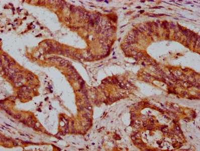 ZDHHC14 Antibody - Immunohistochemistry Dilution at 1:600 and staining in paraffin-embedded human colon cancer performed on a Leica BondTM system. After dewaxing and hydration, antigen retrieval was mediated by high pressure in a citrate buffer (pH 6.0). Section was blocked with 10% normal Goat serum 30min at RT. Then primary antibody (1% BSA) was incubated at 4°C overnight. The primary is detected by a biotinylated Secondary antibody and visualized using an HRP conjugated SP system.